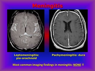 Leptomeningitis:
pia-arachnoid
Meningitis
Pachymeningitis: dura
Most common imaging findings in meningitis: NONE !!
 