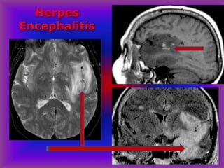 Herpes
Encephalitis
 