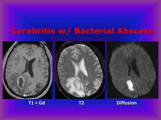 Cerebritis w/ Bacterial Abscess
T1 + Gd T2 Diffusion
 