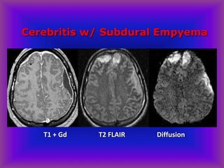 Cerebritis w/ Subdural Empyema
T1 + Gd T2 FLAIR Diffusion
 