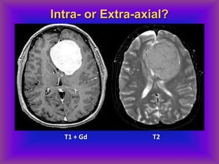 T1 + Gd T2
Intra- or Extra-axial?
 