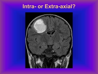 Intra- or Extra-axial?
 
