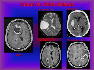 Tumor vs. Other Masses
Arachnoid Cyst
Abscess
Hematoma
“Tumefactive” MS
GBM
 