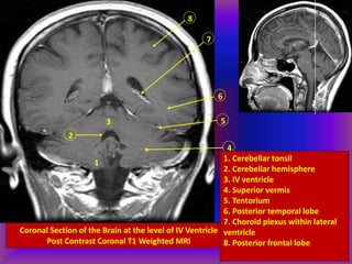Coronal Section of the Brain at the level of IV Ventricle
Post Contrast Coronal T1 Weighted MRI
8
7
6
5
4
3
2
1
1. Cerebellar tonsil
2. Cerebellar hemisphere
3. IV ventricle
4. Superior vermis
5. Tentorium
6. Posterior temporal lobe
7. Choroid plexus within lateral
ventricle
8. Posterior frontal lobe
 