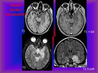 T1 T1 + Gd
T2 T2 FLAIR
Tumor?
Stroke?
Encephalitis?
 