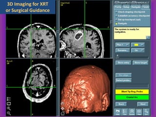 3D Imaging for XRT
or Surgical Guidance
 
