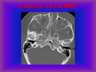 Fractures: CT not MRI !
 