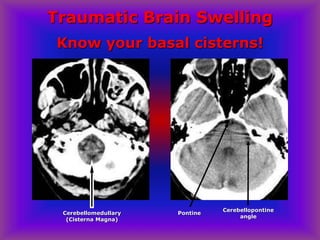 Traumatic Brain Swelling
Cerebellopontine
angle
PontineCerebellomedullary
(Cisterna Magna)
Know your basal cisterns!
 