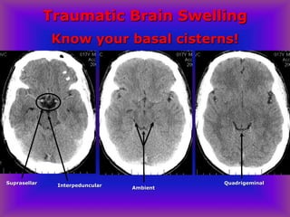 Traumatic Brain Swelling
Know your basal cisterns!
Quadrigeminal
Interpeduncular
Suprasellar
Ambient
 