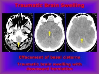Effacement of basal cisterns
Traumatic brain swelling with
downward herniation
Traumatic Brain Swelling
 