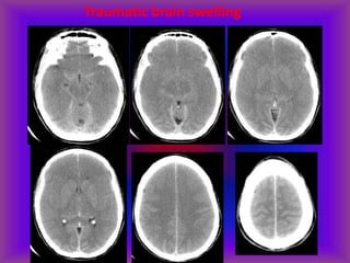 Traumatic brain swelling
 