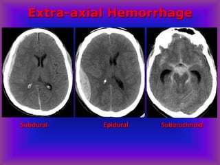 Extra-axial Hemorrhage
Subdural Epidural Subarachnoid
 
