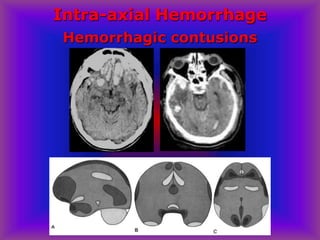 Intra-axial Hemorrhage
Hemorrhagic contusions
 