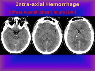 Diffuse Axonal (Shear) Injury (DAI)
Intra-axial Hemorrhage
 