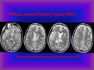 Diffuse Axonal (Shear) Injury (DAI)
T2: Reveals non-hemorrhagic lesions occult on CT
 