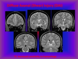 Diffuse Axonal (Shear) Injury (DAI)
T2: Increased sensitivity to hemorrhage
 