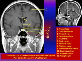 Coronal Section of the Brain at the level of Pituitary gland
Post Contrast Coronal T1 Weighted MRI
1
2
3
4
5
6
78
9
10
11
12
1. Frontal lobe
2. Corpus callosum
3. Frontal horn
4. Caudate nucleus
5. III ventricle
6. Optic nerve
7. Pituitary stalk
8. Pituitary gland
9. Internal carotid artery
10. Cavernous sinus
11. Sphenoid sinus
12. Nasopharynx
 