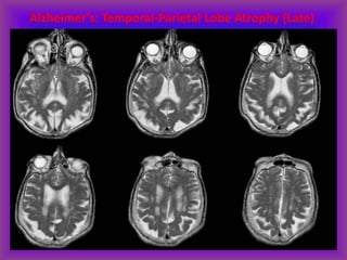 Alzheimer’s: Temporal-Parietal Lobe Atrophy (Late)
 