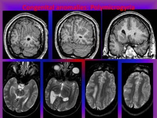 Congenital anomalies: Polymicrogyria
 