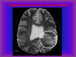 Congenital anomalies: Schizencephaly
 