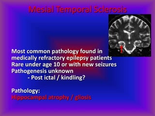 Mesial Temporal Sclerosis
Most common pathology found in
medically refractory epilepsy patients
Rare under age 10 or with new seizures
Pathogenesis unknown
- Post ictal / kindling?
Pathology:
Hippocampal atrophy / gliosis
 