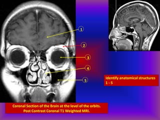 Coronal Section of the Brain at the level of the orbits.
Post Contrast Coronal T1 Weighted MRI.
1
2
3
4
5
Identify anatomical structures
1 - 5
 