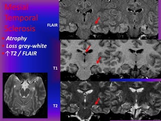 Mesial
Temporal
Sclerosis
FLAIR
T1
T2
• Atrophy
• Loss gray-white
•↑T2 / FLAIR
 