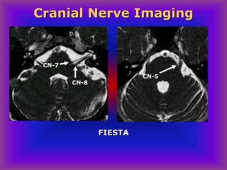 Cranial Nerve Imaging
FIESTA
CN-5
CN-8
CN-7
 