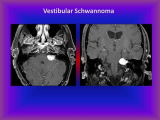 Vestibular Schwannoma
 