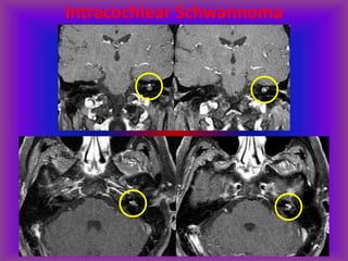 Intracochlear Schwannoma
 