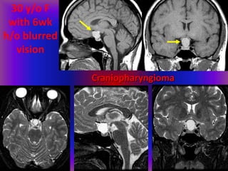 30 y/o F
with 6wk
h/o blurred
vision
Craniopharyngioma
 