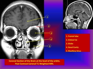 Coronal Section of the Brain at the level of the orbits.
Post Contrast Coronal T1 Weighted MRI.
1
2
3
4
5
1. Frontal lobe
2. Orbital Fat
3. Globe
4. Nasal Cavity
5. Maxillary Sinus
 