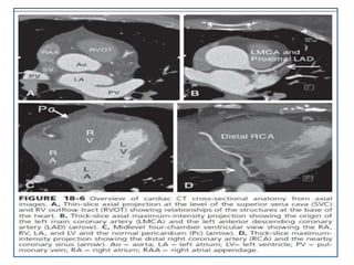 CARDIAC COMPUTED TOMOGRAPHY ANATOMY
 