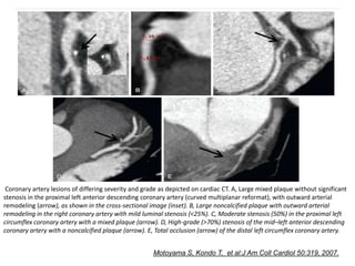 Coronary artery lesions of differing severity and grade as depicted on cardiac CT. A, Large mixed plaque without significant
stenosis in the proximal left anterior descending coronary artery (curved multiplanar reformat), with outward arterial
remodeling (arrow), as shown in the cross-sectional image (inset). B, Large noncalcified plaque with outward arterial
remodeling in the right coronary artery with mild luminal stenosis (<25%). C, Moderate stenosis (50%) in the proximal left
circumflex coronary artery with a mixed plaque (arrow). D, High-grade (>70%) stenosis of the mid–left anterior descending
coronary artery with a noncalcified plaque (arrow). E, Total occlusion (arrow) of the distal left circumflex coronary artery.
Motoyama S, Kondo T, et al:J Am Coll Cardiol 50:319, 2007.
 