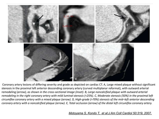 Toheed Ct Angio Ct angio in cardiology | PPT