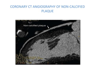 CORONARY CT ANGIOGRAPHY OF NON-CALCIFIED
PLAQUE
 