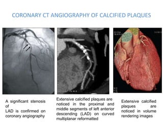 CORONARY CT ANGIOGRAPHY OF CALCIFIED PLAQUES
A significant stenosis
of
LAD is confirmed on
coronary angiography
Extensive calcified plaques are
noticed in the proximal and
middle segments of left anterior
descending (LAD) on curved
multiplanar reformatted
Extensive calcified
plaques are
noticed in volume
rendering images
 