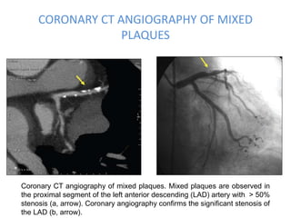 CORONARY CT ANGIOGRAPHY OF MIXED
PLAQUES
Coronary CT angiography of mixed plaques. Mixed plaques are observed in
the proximal segment of the left anterior descending (LAD) artery with > 50%
stenosis (a, arrow). Coronary angiography confirms the significant stenosis of
the LAD (b, arrow).
 