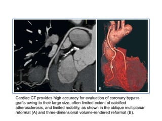 Cardiac CT provides high accuracy for evaluation of coronary bypass
grafts owing to their large size, often limited extent of calcified
atherosclerosis, and limited mobility, as shown in the oblique multiplanar
reformat (A) and three-dimensional volume-rendered reformat (B).
 