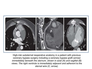 High-risk substernal reoperative anatomy in a patient with previous
coronary bypass surgery including a coronary bypass graft (arrow)
immediately beneath the sternum, shown in axial (A) and sagittal (B)
views. The right ventricle is immediately adjacent and adherent to the
sternal wire (C, arrow).
 