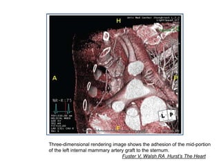 Three-dimensional rendering image shows the adhesion of the mid-portion
of the left internal mammary artery graft to the sternum.
Fuster V, Walsh RA Hurst’s The Heart
 