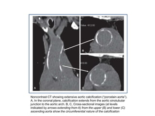 Noncontrast CT showing extensive aortic calcification (“porcelain aorta”).
A, In the coronal plane, calcification extends from the aortic sinotubular
junction to the aortic arch. B, C, Cross-sectional images (at levels
indicated by arrows extending from A) from the upper (B) and lower (C)
ascending aorta show the circumferential nature of the calcification
 
