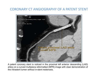 CORONARY CT ANGIOGRAPHY OF A PATENT STENT
A patent coronary stent is noticed in the proximal left anterior descending (LAD)
artery on a curved multiplana reformatted (MPR) image with clear demonstration of
the intrastent lumen without in-stent restenosis.
 