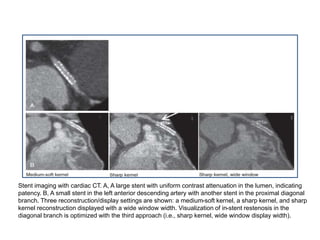 Stent imaging with cardiac CT. A, A large stent with uniform contrast attenuation in the lumen, indicating
patency. B, A small stent in the left anterior descending artery with another stent in the proximal diagonal
branch. Three reconstruction/display settings are shown: a medium-soft kernel, a sharp kernel, and sharp
kernel reconstruction displayed with a wide window width. Visualization of in-stent restenosis in the
diagonal branch is optimized with the third approach (i.e., sharp kernel, wide window display width).
 