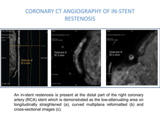 CORONARY CT ANGIOGRAPHY OF IN-STENT
RESTENOSIS
An in-stent restenosis is present at the distal part of the right coronary
artery (RCA) stent which is demonstrated as the low-attenuating area on
longitudinally straightened (a), curved multiplana reformatted (b) and
cross-sectional images (c).
 
