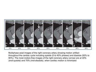 Multiphase axial images of the right coronary artery showing motion artifact
throughout the cardiac cycle including systole (0 to 40% phases) and diastole (50% to
90%). The most motion-free images of the right coronary artery (arrow) are at 40%
(end-systole) and 70% (mid-diastole), when cardiac motion is minimized.
 