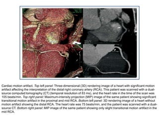 Cardiac motion artifact. Top left panel: Three-dimensional (3D) rendering image of a heart with significant motion
artifact affecting the interpretation of the distal right coronary artery (RCA). This patient was scanned with a dual-
source computed tomography (CT) (temporal resolution of 83 ms), and the heart rate in the time of the scan was
105 beats/min. Top right panel: Maximum-intensity projection (MIP) image of the same patient showing significant
transitional motion artifact in the proximal and mid RCA. Bottom left panel: 3D rendering image of a heart without
motion artifact showing the distal RCA. The heart rate was 75 beats/min, and the patient was scanned with a dual-
source CT. Bottom right panel: MIP image of the same patient showing only slight transitional motion artifact in the
mid RCA.
 