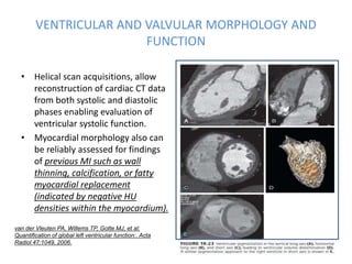 VENTRICULAR AND VALVULAR MORPHOLOGY AND
FUNCTION
• Helical scan acquisitions, allow
reconstruction of cardiac CT data
from both systolic and diastolic
phases enabling evaluation of
ventricular systolic function.
• Myocardial morphology also can
be reliably assessed for findings
of previous MI such as wall
thinning, calcification, or fatty
myocardial replacement
(indicated by negative HU
densities within the myocardium).
van der Vleuten PA, Willems TP, Gotte MJ, et al:
Quantification of global left ventricular function:. Acta
Radiol 47:1049, 2006.
 