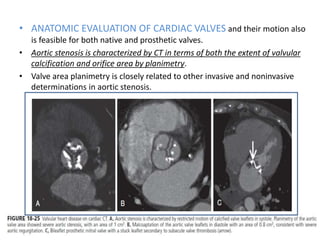 • ANATOMIC EVALUATION OF CARDIAC VALVES and their motion also
is feasible for both native and prosthetic valves.
• Aortic stenosis is characterized by CT in terms of both the extent of valvular
calcification and orifice area by planimetry.
• Valve area planimetry is closely related to other invasive and noninvasive
determinations in aortic stenosis.
 