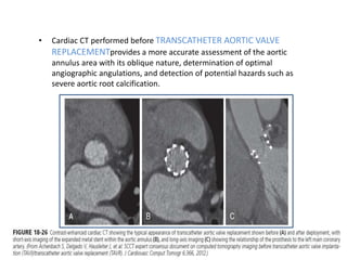 • Cardiac CT performed before TRANSCATHETER AORTIC VALVE
REPLACEMENTprovides a more accurate assessment of the aortic
annulus area with its oblique nature, determination of optimal
angiographic angulations, and detection of potential hazards such as
severe aortic root calcification.
 